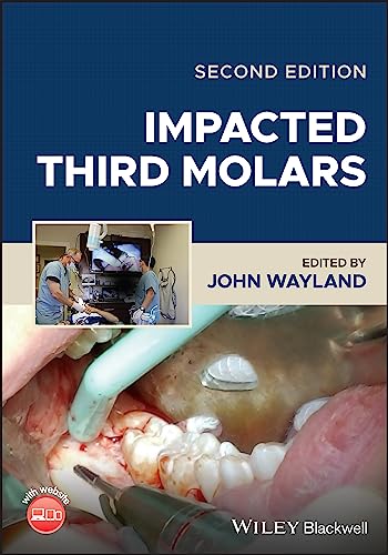 Impacted Third Molars