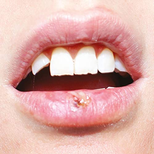Close-up of a smiling mouth with visible teeth and a cold sore.