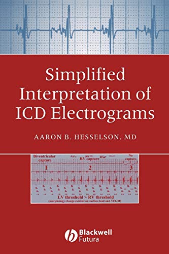 Simplified Interpretation of ICD Electrograms