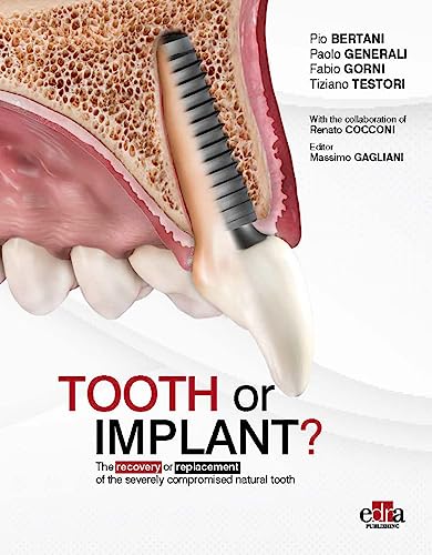 Tooth or implant?