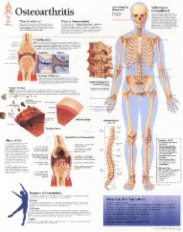Osteoarthritis Paper Poster